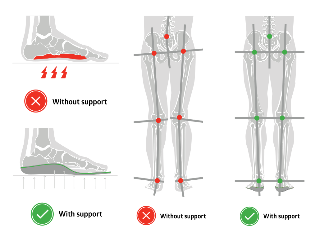Illustration showing the effects of support on leg structure and foot positioning.